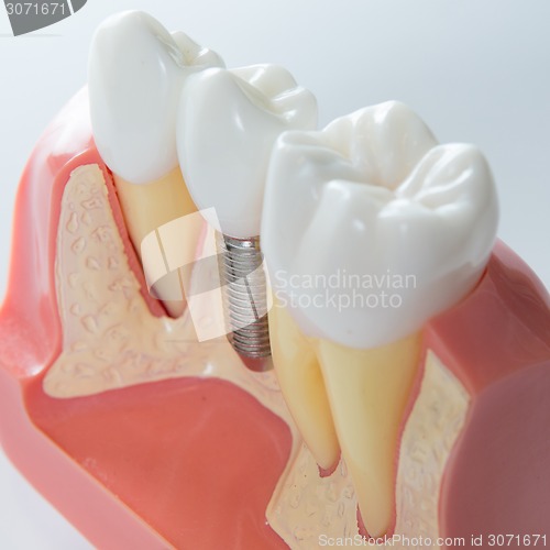 Image of Dental implant