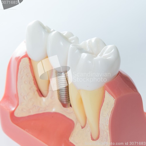 Image of Dental implant