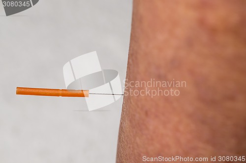 Image of acupuncture treatment on leg