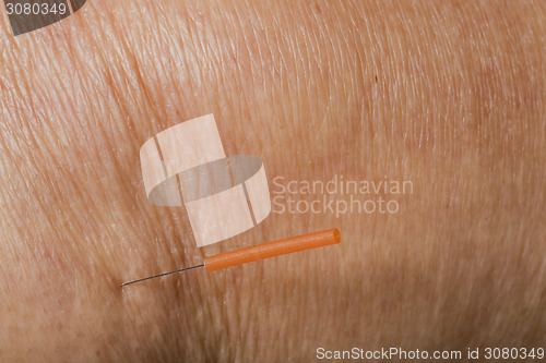 Image of acupuncture treatment on leg