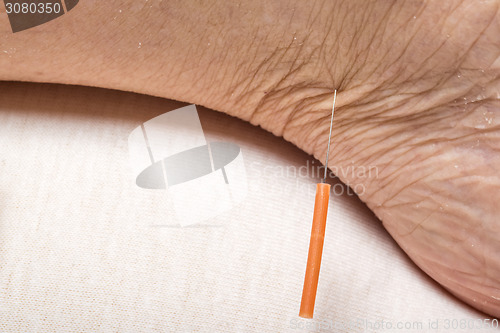 Image of acupuncture treatment on leg