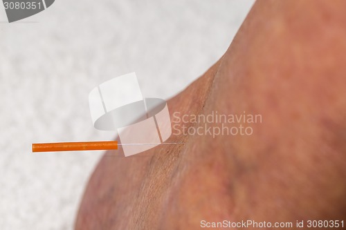 Image of acupuncture treatment on leg