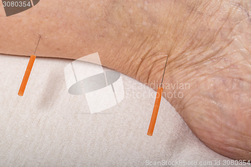 Image of acupuncture treatment on leg