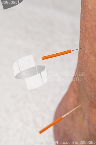 Image of acupuncture treatment on leg