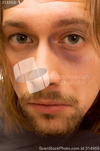 Image of Young man with black eye