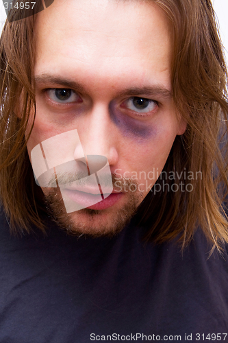 Image of Young man with black eye