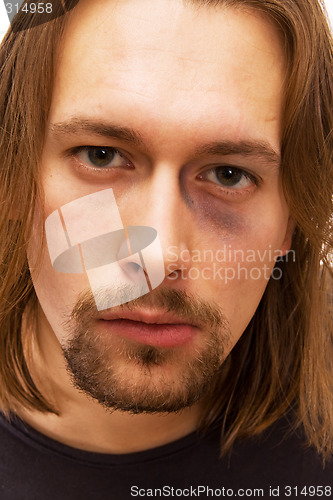 Image of Young man with black eye