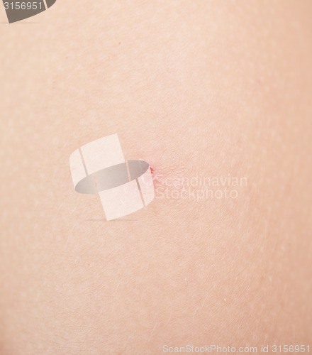 Image of insect bite