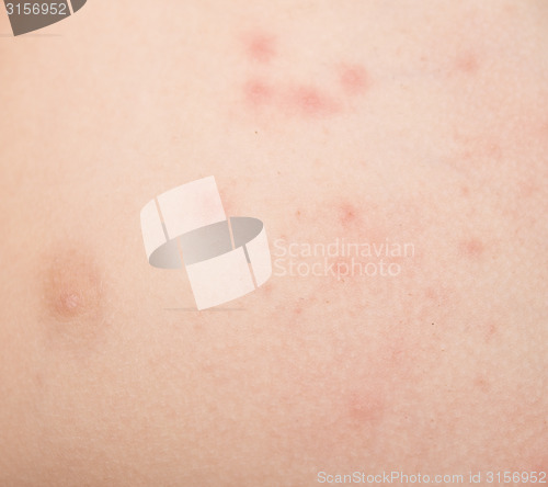 Image of rash