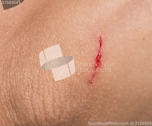 Image of wound