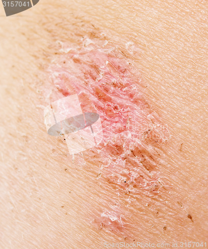 Image of wound