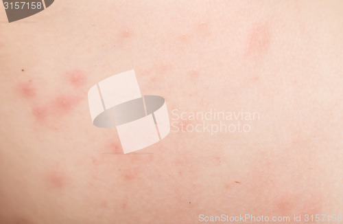 Image of rash