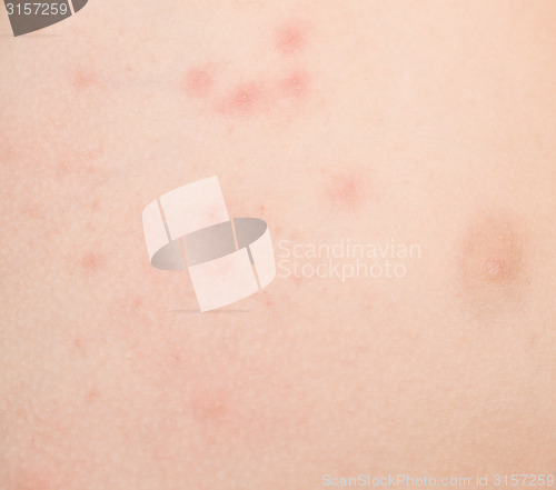 Image of rash