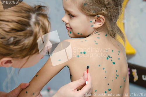 Image of Little girl with chickenpox sores smeared zelenkoj