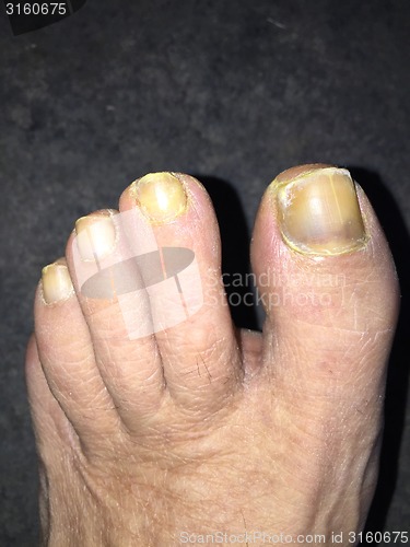 Image of Toe nails with mucosis