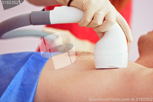 Image of male laser epilation