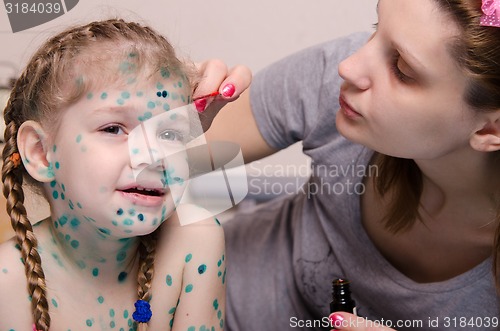 Image of Mom misses zelenkoj rash on face of child with chickenpox