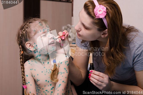 Image of Mom smears child with chickenpox sores zelenkoj