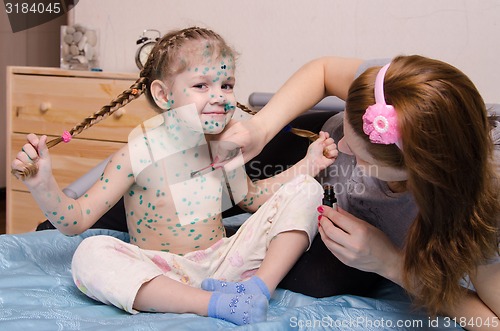 Image of Mom misses zelenkoj chickenpox rash on chest of child