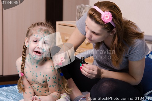 Image of Girl suffering from chicken pox yells when my mother misses sores zelenkoj