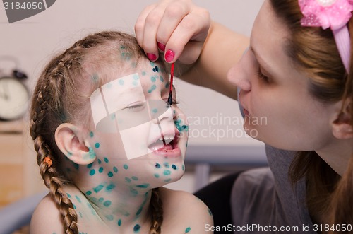 Image of Mom misses zelenkoj sores in a child with chickenpox