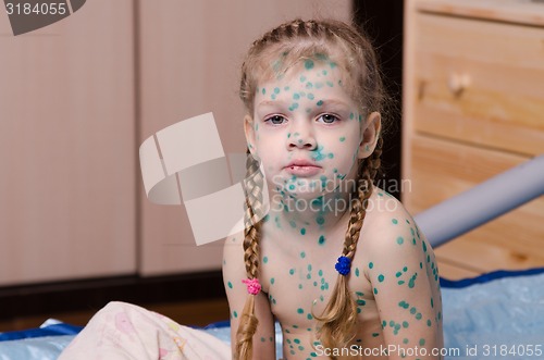 Image of The little girl suffering from chicken pox all smeared zelenkoj