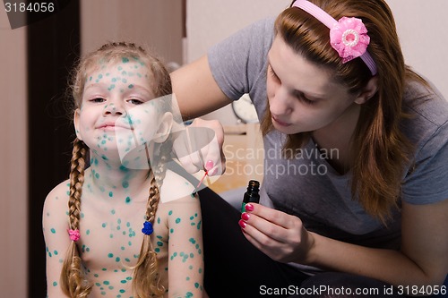 Image of Mom misses the little girl with chickenpox sores zelenkoj