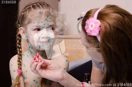 Image of Mom cauterize zelenkoj rash in a child with chickenpox