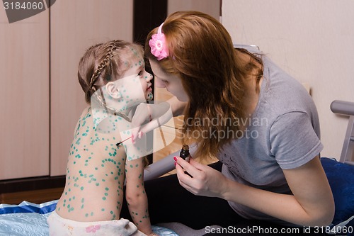 Image of Girl suffering from chickenpox sores mom misses zelenkoj