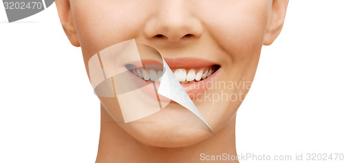 Image of teeth whitening, before and after