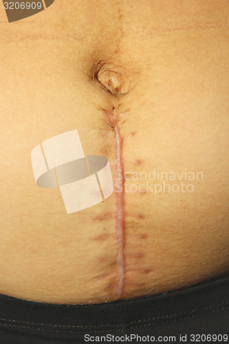 Image of seams after the operation of Caesarian section