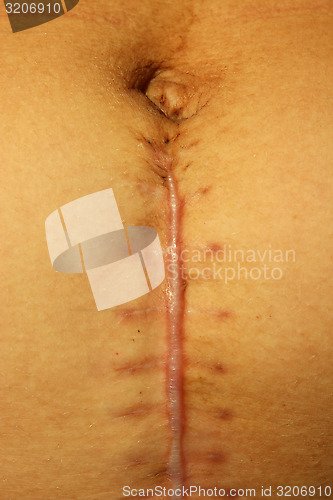 Image of seams after the operation of Caesarian section