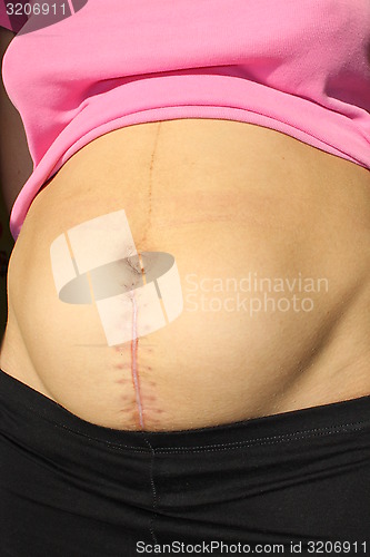 Image of seams after the operation of Caesarian section