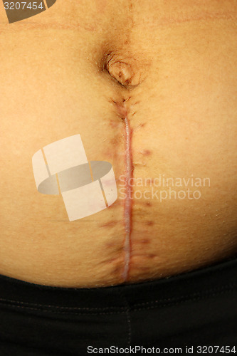 Image of seams after the operation of Caesarian section