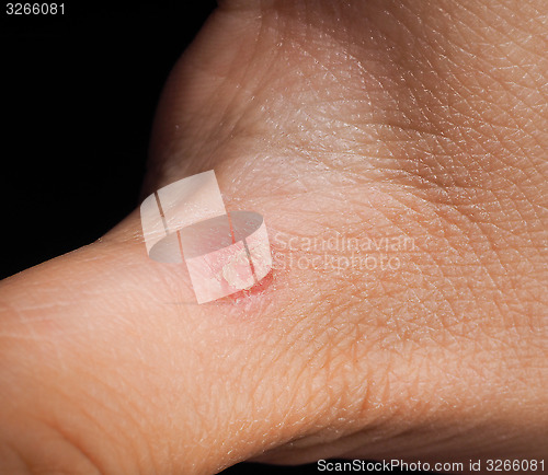 Image of Closeup of injury on hand below thumb isolated towards black bac