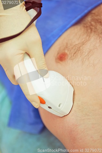 Image of male laser epilation