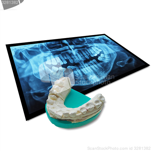 Image of Xray of teeth with positive teeth cast