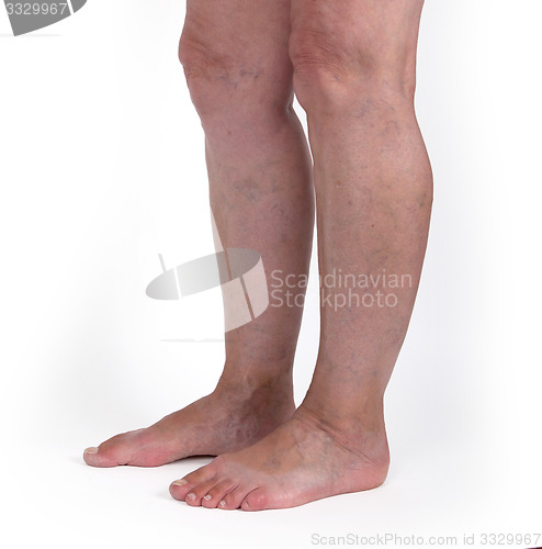 Image of Old woman with varicose veins