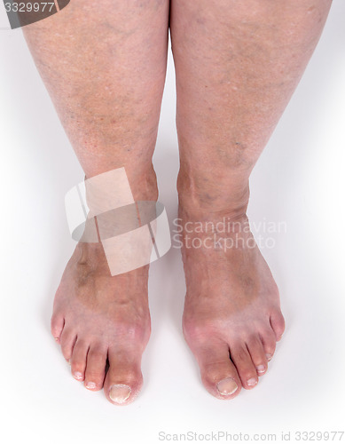 Image of Old woman with varicose veins