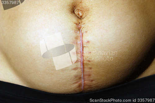 Image of seams after the operation of Caesarian section