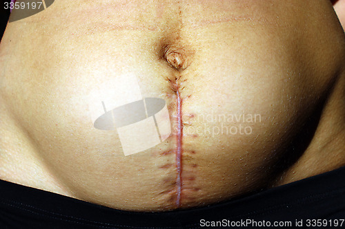 Image of seams after the operation of Caesarian section