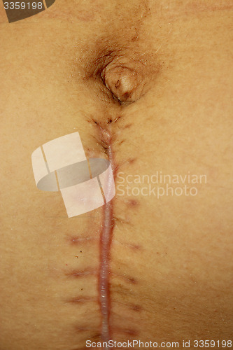 Image of seams after the operation of Caesarian section