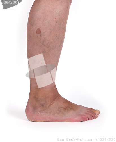 Image of Old woman with varicose veins