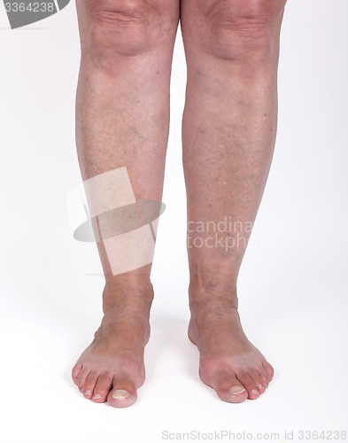 Image of Old woman with varicose veins