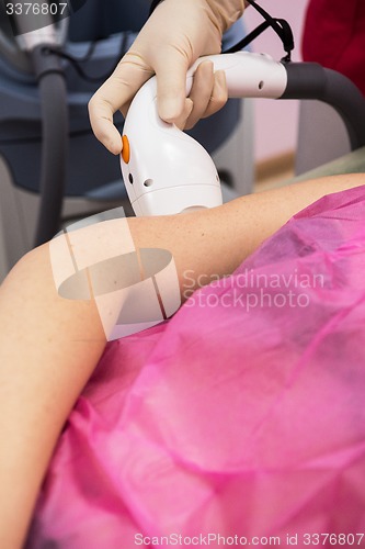 Image of photo epilation