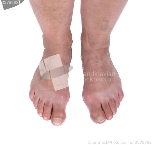 Image of Old woman with varicose veins