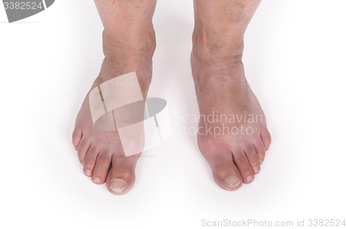 Image of Old woman with varicose veins