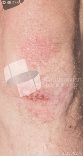 Image of wound