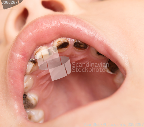 Image of caries