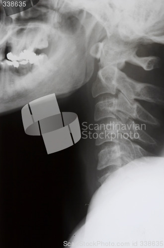 Image of X-ray